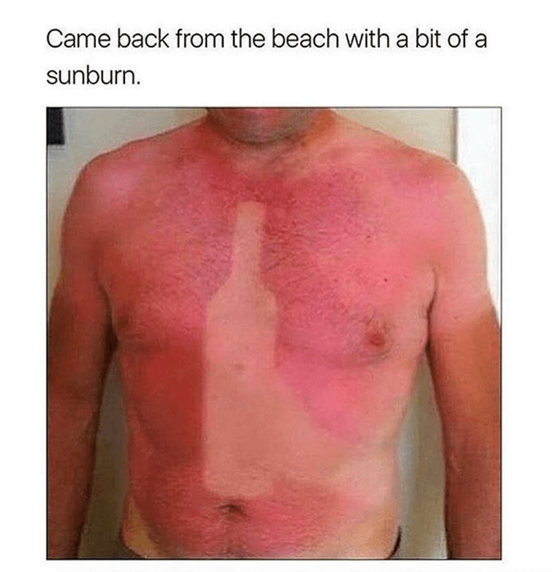 came-back-beach-with-bit-sunburn